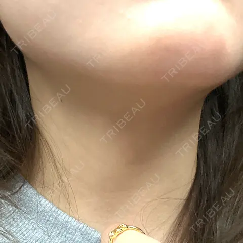 ハイフ（顔） Mavie Beauty Clinic （マヴィービューティークリニック） AFTER