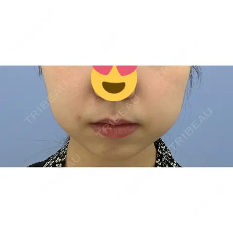 糸リフト / バッカルファット除去 / 脂肪吸引（顔） 湘南美容クリニック 銀座院 AFTER