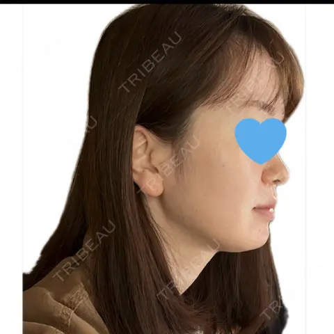 ハイフ（顔） Mavie Beauty Clinic （マヴィービューティークリニック） AFTER