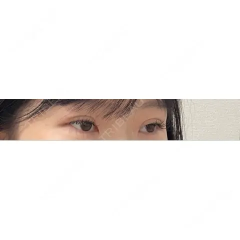 二重埋没 美容外科川崎クリニック 大阪梅田院 AFTER