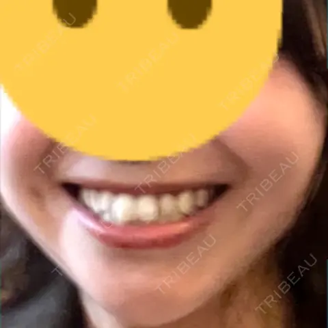ボトックス（あご） / ボトックス（エラ・小顔） / ボトックス（口角） / ボトックス（額） / ボトックス（人中） BiBiクリニック AFTER