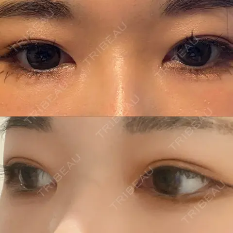 二重切開 / 鼻尖形成（切開） / 鼻中隔延長（切開） / 小鼻縮小（切開） / 軟骨移植 / ワシ鼻修正・ハンプ切除 / 鼻尖縮小 / 切開リフト LUHO（ルホ）美容外科 AFTER