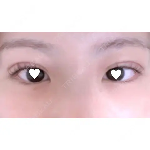 二重埋没 シンデレラ＆ダヴィンチクリニック AFTER