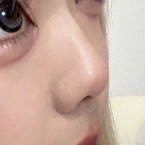 隆鼻術 / 鼻尖形成（切開） / 鼻中隔延長（切開） / 軟骨移植 R Beauty CLINIC 大阪院 AFTER