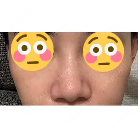 鼻尖形成（切開） / 鼻尖縮小 / 小鼻縮小（非切開） 銀座マイアミ美容外科 AFTER