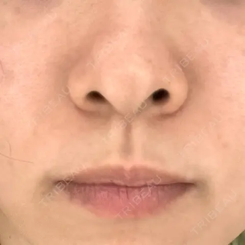 ヒアルロン酸注入（鼻翼基部） おおたかの森ビューティークリニック AFTER