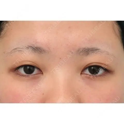 二重埋没 WOM CLINIC GINZA （ワム クリニック ギンザ） AFTER