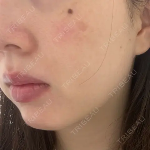 ルメッカ GLAMRULE CLINIC (グラムルール クリニック) 銀座院 AFTER