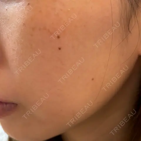 イオン導入 / ピーリング（ハリ・ツヤ） / ルメッカ ルラ美容クリニック 仙台院 AFTER