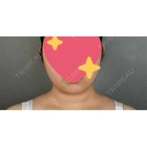 糸リフト / バッカルファット除去 / 脂肪吸引（顔） / ボトックス（エラ・小顔） アリエル美容クリニック 大宮院 AFTER