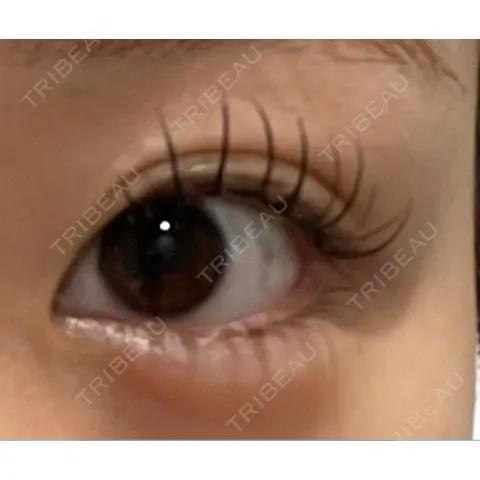 目頭切開 9BeautyClinic AFTER