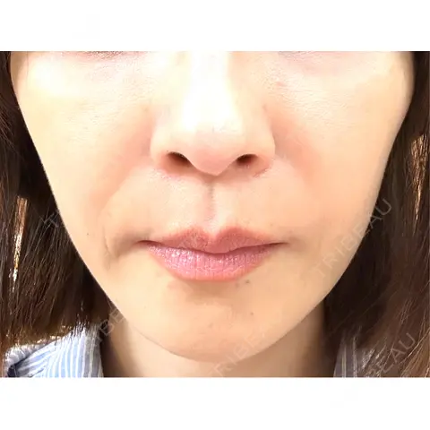ヒアルロン酸注入（頬） 湘南美容クリニック 銀座院 AFTER