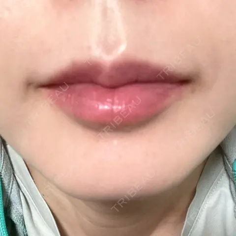 ヒアルロン酸注入（唇） L‘amour clinic Tokyo【ラムールクリニック東京】 AFTER