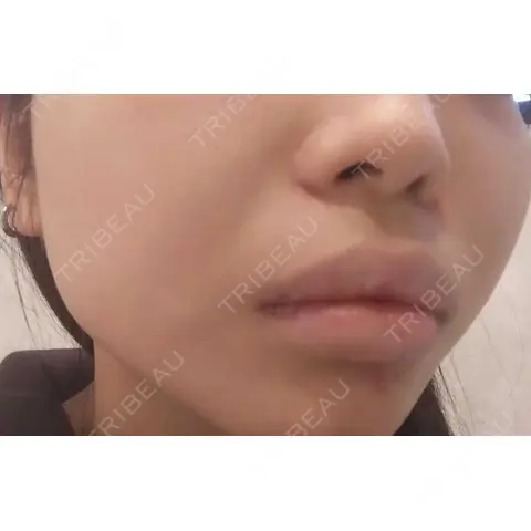 脂肪吸引（顔） / 脂肪吸引注射（顔） ziz CLINIC AFTER