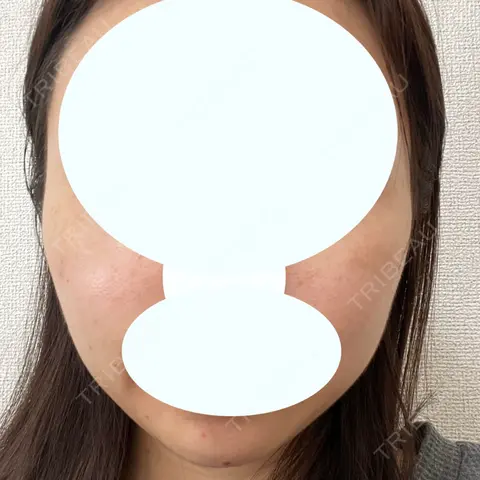 ボトックス（エラ・小顔） ルラ美容クリニック 大宮院 AFTER