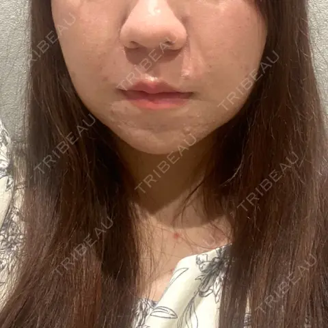 脂肪吸引（顔） / 脂肪吸引注射（顔） ziz CLINIC AFTER
