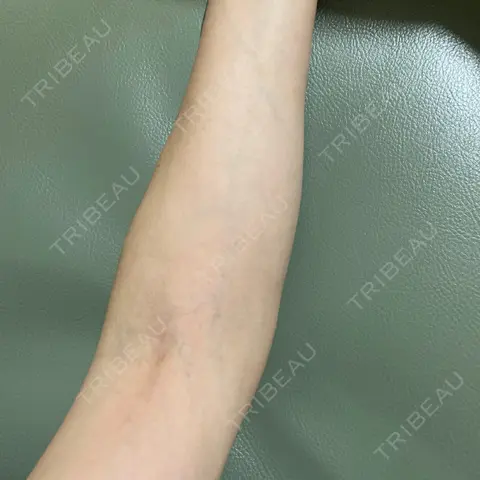 白玉点滴・注射 新宿美容内科医療クリニック AFTER