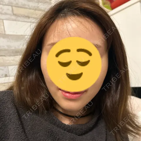 ハイフ（顔） L‘amour clinic Tokyo【ラムールクリニック東京】 AFTER