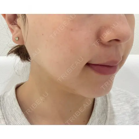 ルメッカ GLAMRULE CLINIC (グラムルール クリニック) 銀座院 AFTER