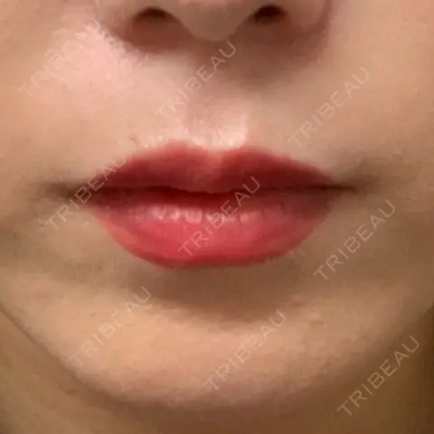 ヒアルロン酸注入（唇） R Beauty CLINIC 銀座院 AFTER