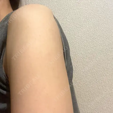 プラセンタ注射 アネシス美容クリニック AFTER