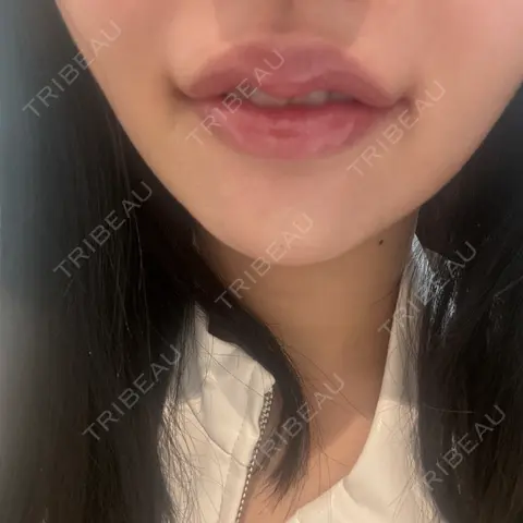 口角挙上 R Beauty CLINIC 銀座院 AFTER