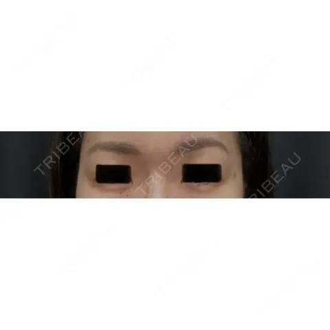 眉下切開 / その他（目元） Z Clinic AFTER