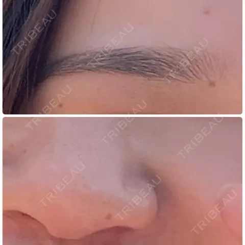 ほくろ・いぼ除去レーザー（肌） Mavie Beauty Clinic （マヴィービューティークリニック） AFTER