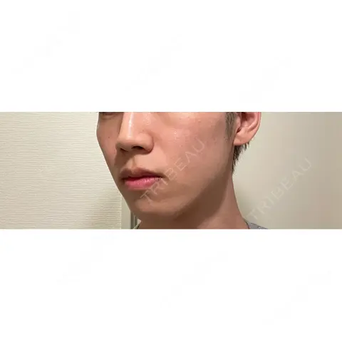 ボトックス（エラ・小顔） / ヒアルロン酸注入（鼻翼基部） KAGA CLINIC AFTER