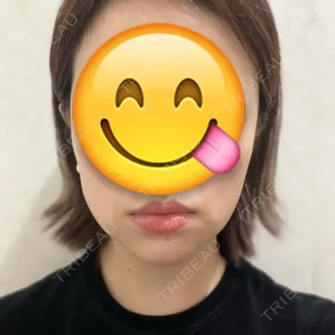 脂肪吸引（顔） Mods Clinic（モッズクリニック） 東京院 AFTER