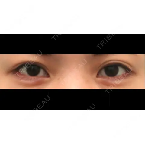 二重切開 / 眼瞼下垂（切開） / 下まぶたたるみ取り / タレ目形成・グラマラスライン（切開） WOM CLINIC GINZA （ワム クリニック ギンザ） AFTER