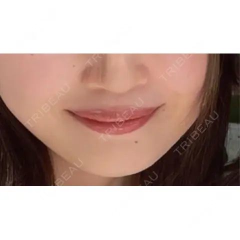 その他（口元） R Beauty CLINIC 銀座院 AFTER