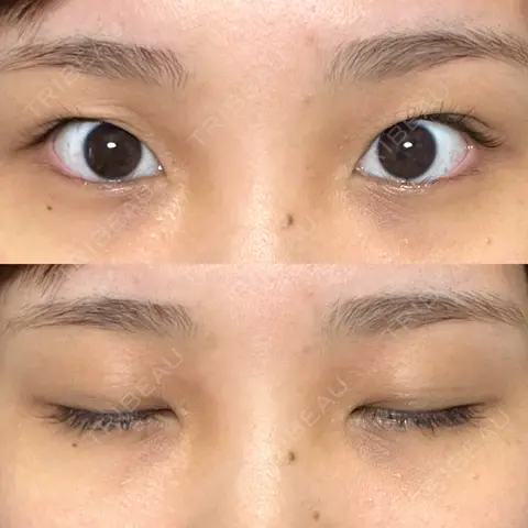 二重切開 / 目頭切開 オーキッド美容クリニック東京御徒町 AFTER