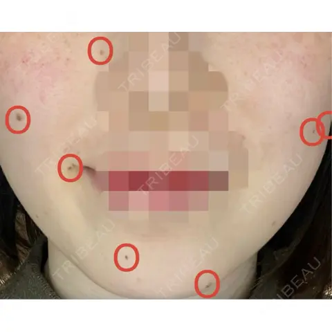 ほくろ・いぼ切除（肌） KARIS beauty clinic AFTER