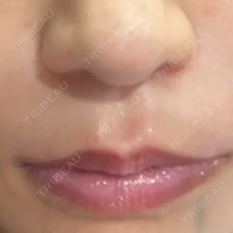 ヒアルロン酸注入（鼻翼基部） 日比谷セントラルクリニック AFTER