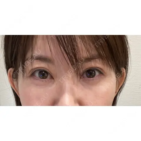 リジュラン DMTC美容皮膚科 日本橋院 AFTER