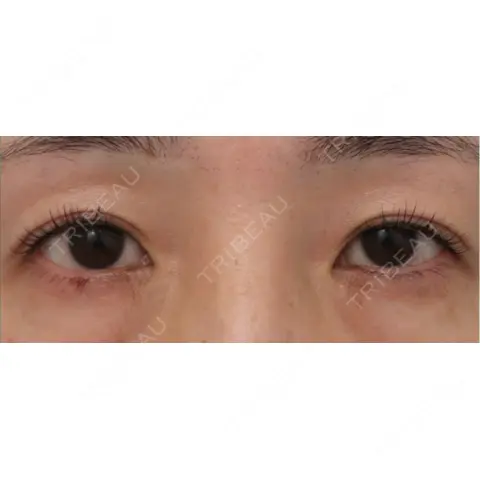 二重埋没 WOM CLINIC GINZA （ワム クリニック ギンザ） AFTER