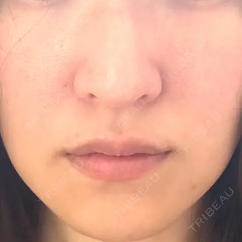 鼻尖形成（非切開） 銀座マイアミ美容外科 AFTER