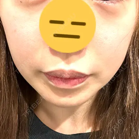 ハイフ（顔） ちぐさ内科クリニック 覚王山 AFTER