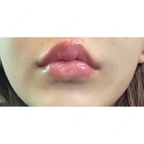ヒアルロン酸注入（唇） L‘amour clinic Tokyo【ラムールクリニック東京】 AFTER