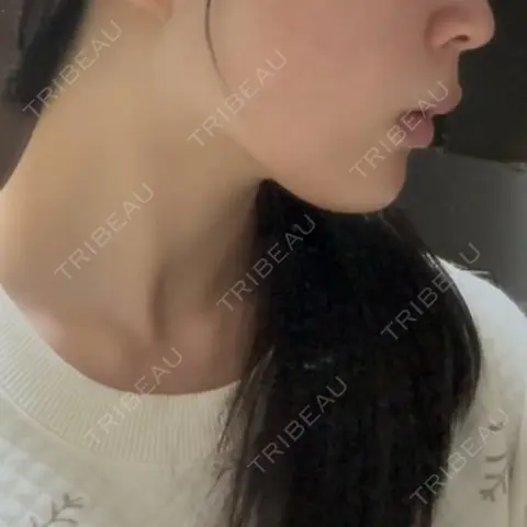 その他（輪郭） ARTE SKIN CLINIC 【アルテスキンクリニック】 AFTER