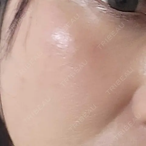 ルメッカ 東京美容外科 名古屋院 AFTER