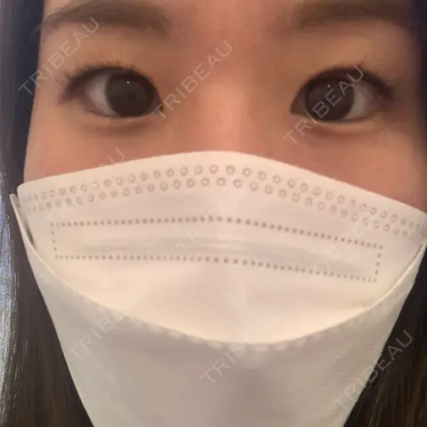 二重埋没 / 眼瞼下垂（非切開） A CLINIC（エークリニック） 銀座院 AFTER