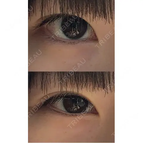 ヒアルロン酸注入（涙袋） 目白ホワイトクリニック AFTER