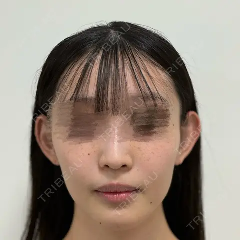 糸リフト / 脂肪吸引（顔） / ジョールファット除去 / 脂肪吸引注射（顔） SEA CLINIC（シークリニック） AFTER