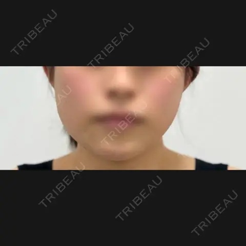 糸リフト / 脂肪吸引（顔） / 脂肪吸引注射（顔） / ヒアルロン酸注入（あご） / ボトックス（エラ・小顔） SEA CLINIC（シークリニック） AFTER