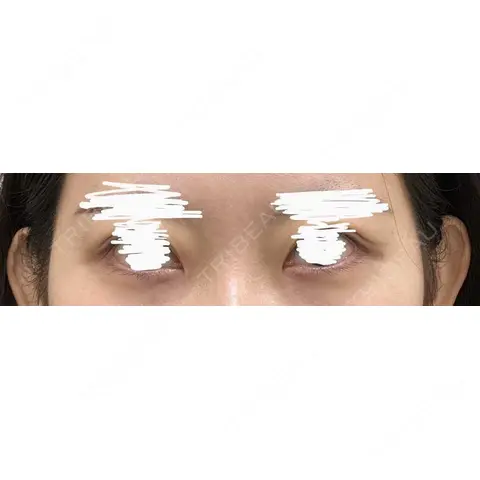 ヒアルロン酸注入（涙袋） / ヒアルロン酸注入（唇） / ボトックス（口角） / ボトックス（人中） KAGA CLINIC AFTER