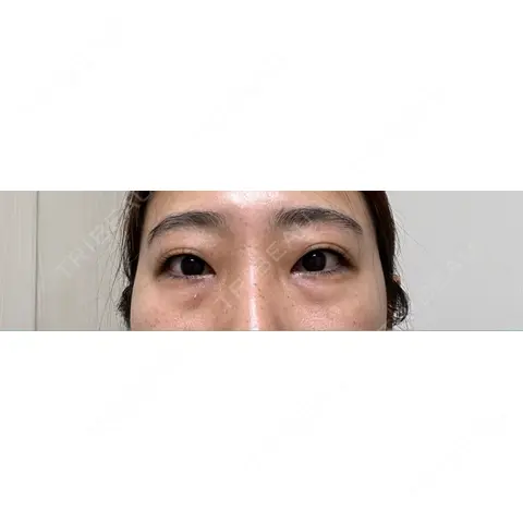 クマ治療 / 下まぶたたるみ取り / 下まぶたの脂肪取り / 脂肪注入（輪郭） 東京シンデレラ美容外科 池袋院 AFTER