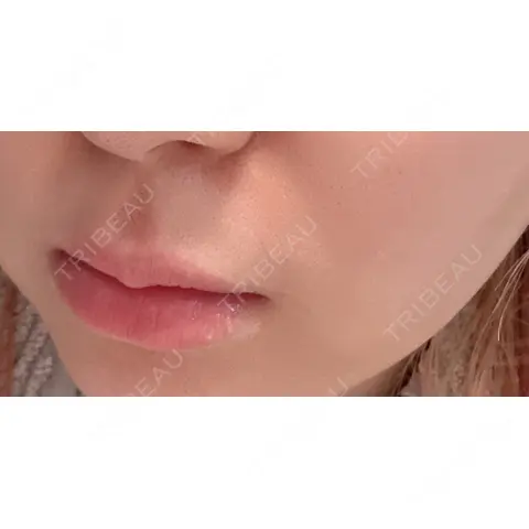 ヒアルロン酸注入（唇） / ボトックス（口角） ルラ美容クリニック 名古屋栄院 AFTER