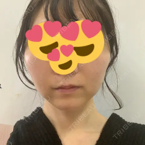 ヒアルロン酸注入（唇） / ボトックス（人中） / RF（高周波）たるみ治療 RIVER CLINIC（リバークリニック） AFTER